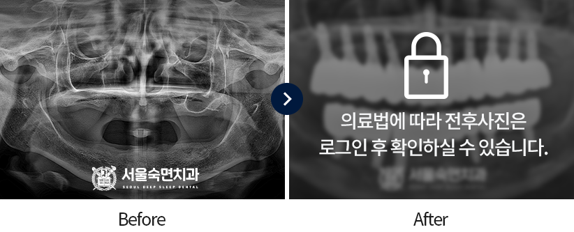 임플란트-전후사진1