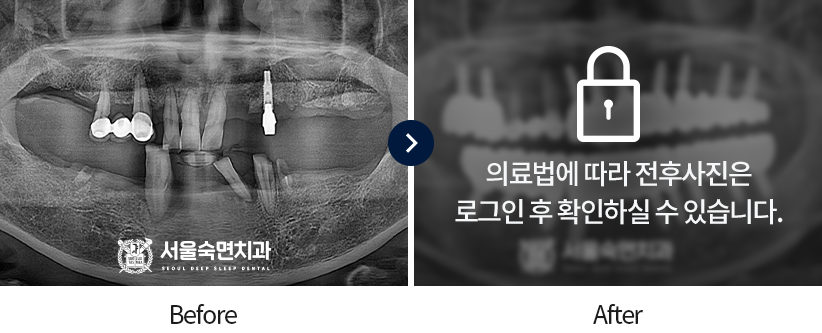 임플란트-전후사진2