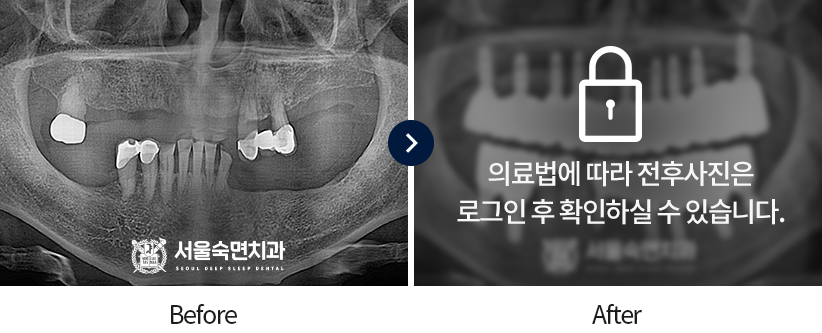 임플란트-전후사진3