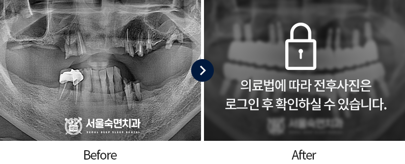 임플란트-전후사진5