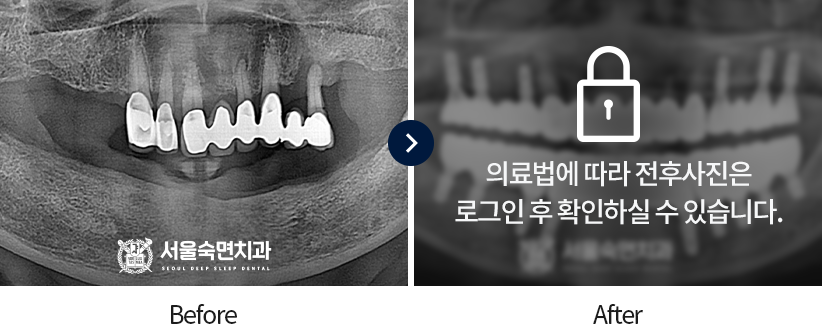 임플란트-전후사진6