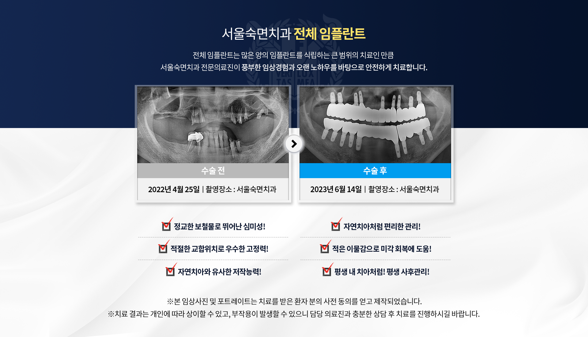 서울숙면치과 전체 임플란트. 전체 임플란트는 대략 20개 이상의 임플란트를 식립하는 큰 범위의 치료인 만큼 서울숙면치과 전문의료진이 풍부한 임상경험과 오랜 노하우를 바탕으로 안전하게 치료합니다.