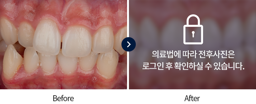 치아교정-전후사진1