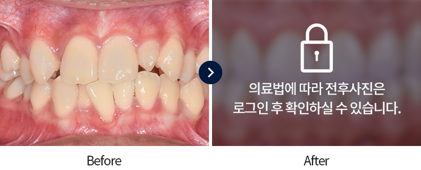 치아교정-전후사진2